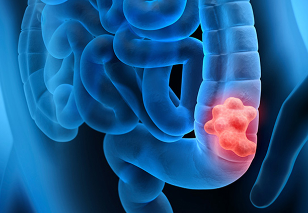 colonic cancers