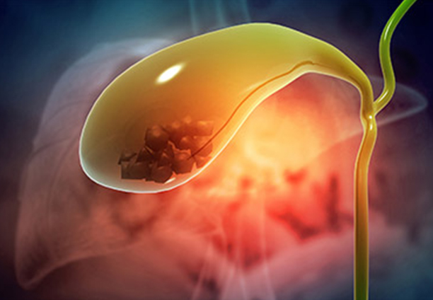 Gall Stone Disease