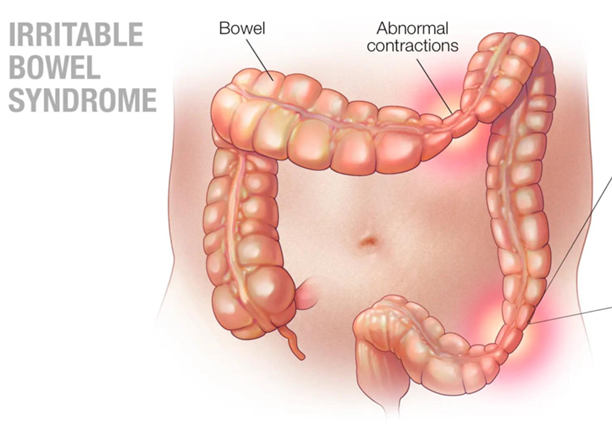 Navigating the Complex World of Irritable Bowel Syndrome (IBS)